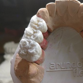 Виготовлення зубних імплантів у стоматології "Smile Design" у Дніпрі. Записуйтесь до стоматолога з акції.