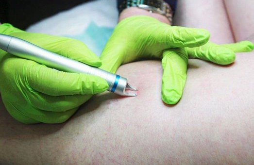 Removal of vascular mesh in "Touch Light Cosmetology" cosmetology Kiev. Sign up for a vascular mesh removal at a discount.