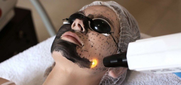 Карбоновий пілінг у студії «Beauty Factory» у Києві. Записатися по знижці