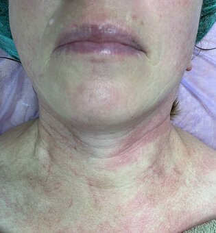 Омоложение зоны декольте в студии косметологии «LaEsthetics» в Киеве. Записаться на процедуры со скидкой.