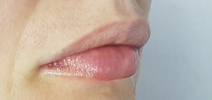 Увеличение губ в косметологии «DAskar cosmetology clinic» в Киеве. Записаться по акции