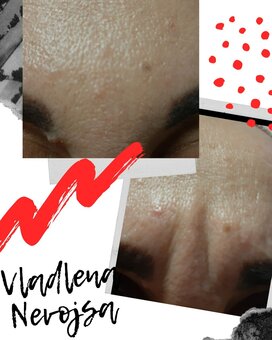 Facial rejuvenation from beautician Vladlena Bobrova in Dnipro. Sign up for the procedure for the promotion.