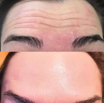 Косметологічний кабінет Олени Кузьменко в києві. розгладження зморшок, акція.