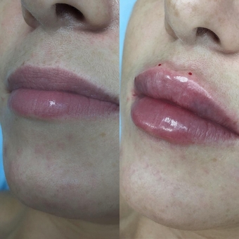 Косметолог Олена Кузьменко в Києві. пластика губ зі знижкою.