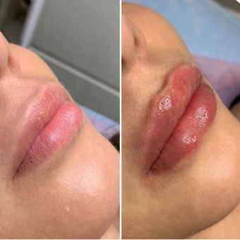 Косметологічний кабінет Олени Кузьменко в Києві. контурна пластика зі знижкою.