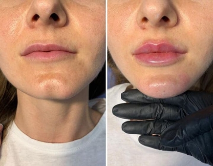 Косметологічний кабінет Олени Кузьменко в Києві. поліпшення форми губ зі знижкою.