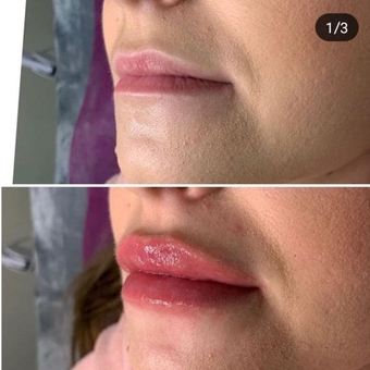 Косметологічний кабінет Олени Кузьменко в Києві. поліпшення форми губ, знижки.