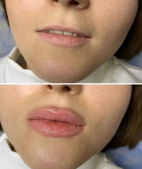 Косметологічний кабінет Олени Кузьменко в Києві. зробити губи зі знижкою.