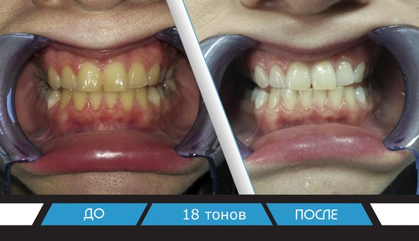 Безболезненное отбеливание зубов в стоматологической клинике «Smile to you» в Днепре. Записаться со скидкой